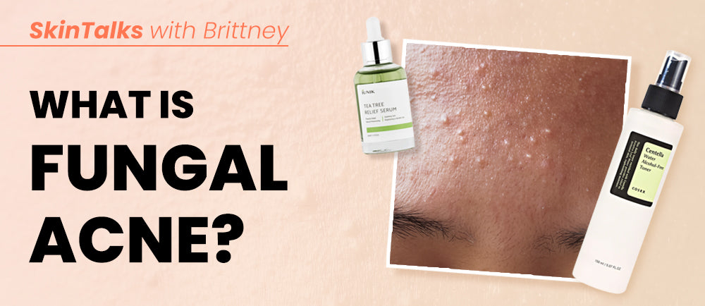 O que é acne fúngica? 