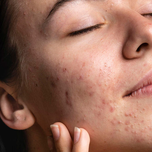 O que é a Acne Fúngica?